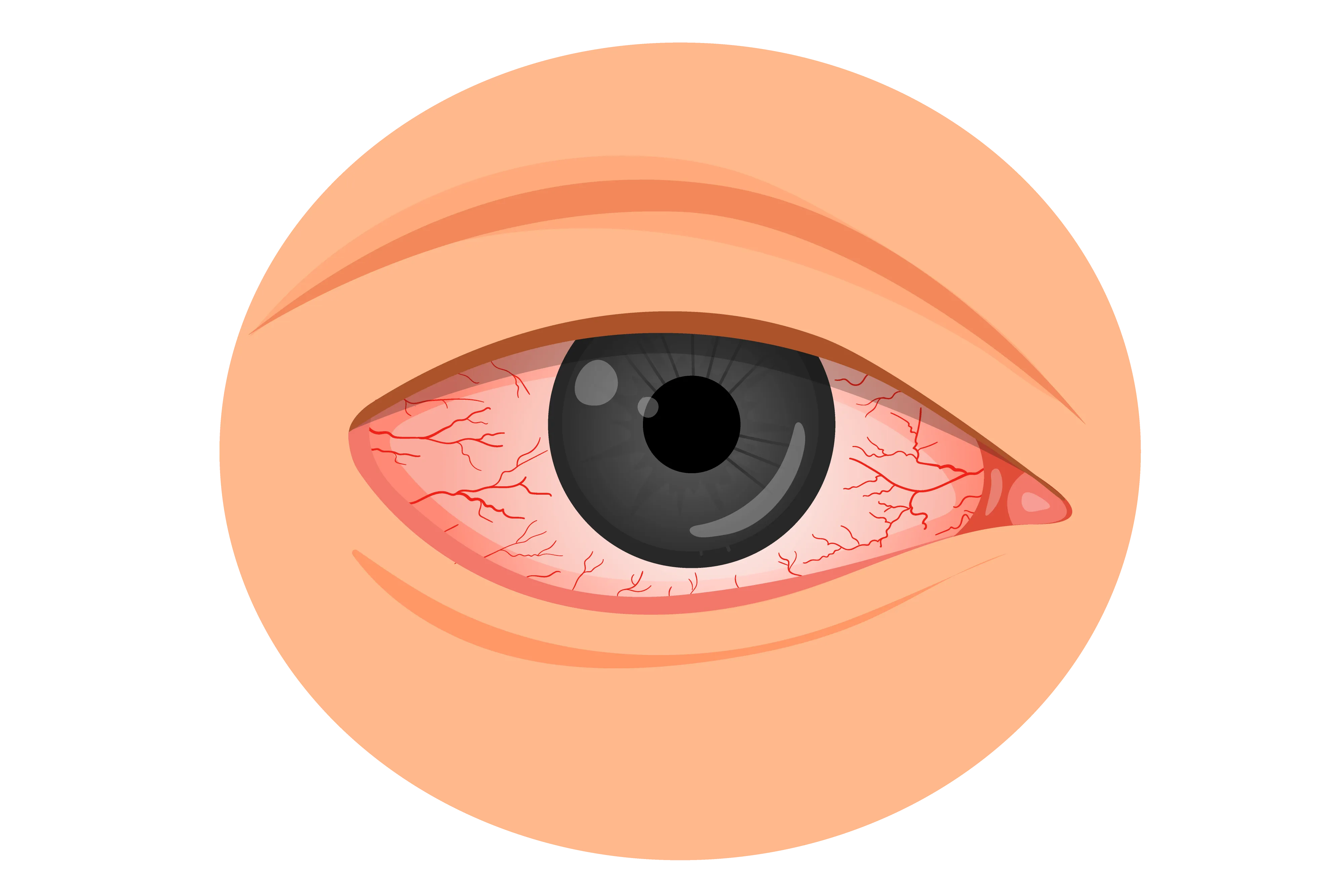red-eye